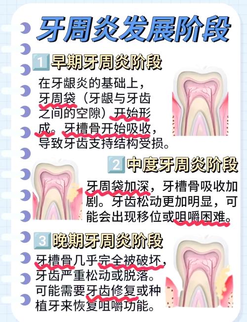 牙周炎有简易除法吗？这些方法真的有效吗？-图2