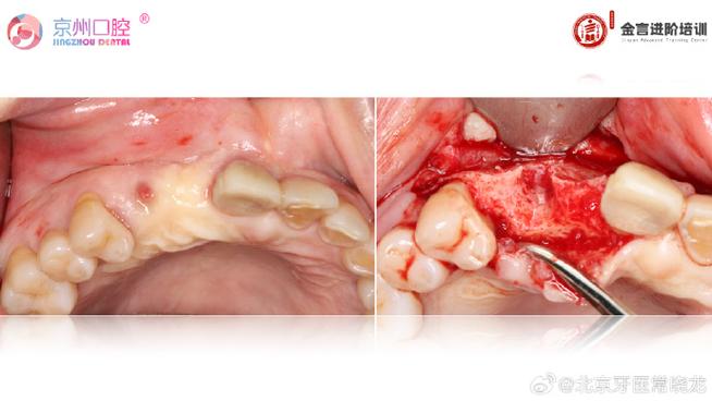 正畸与引导组织再生术-图1
