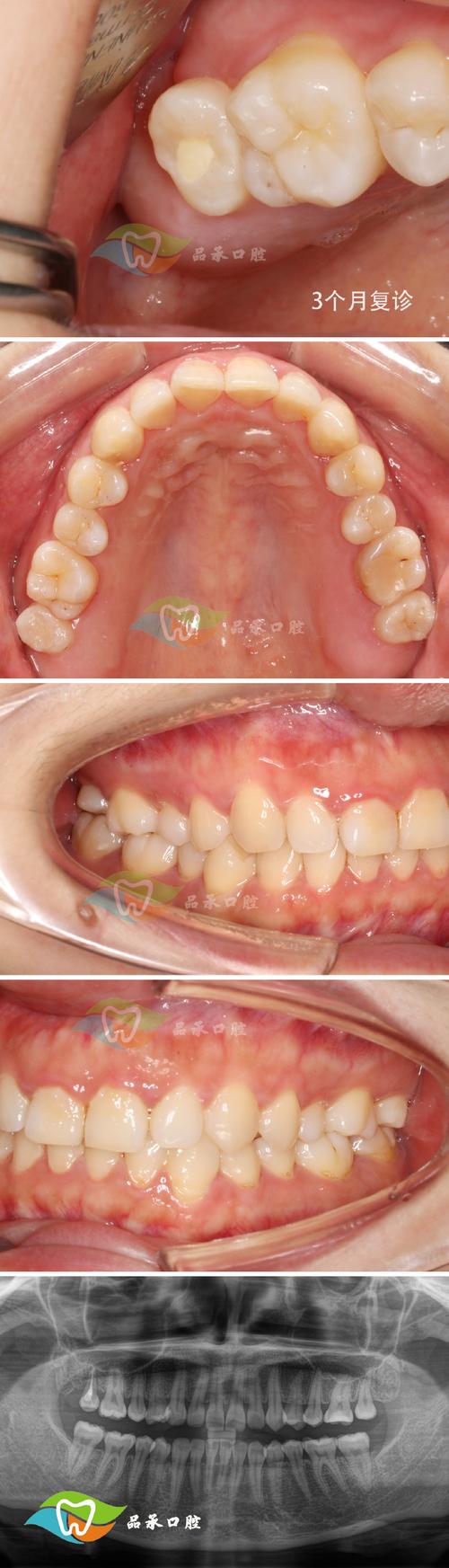 正畸与引导组织再生术-图3