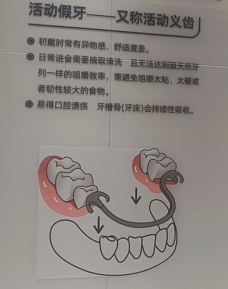 活动义齿就位方法有哪些实用操作步骤和技巧？-图1