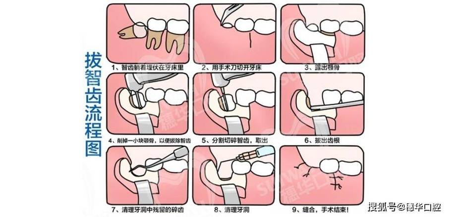 成人智齿拔除方法-图1