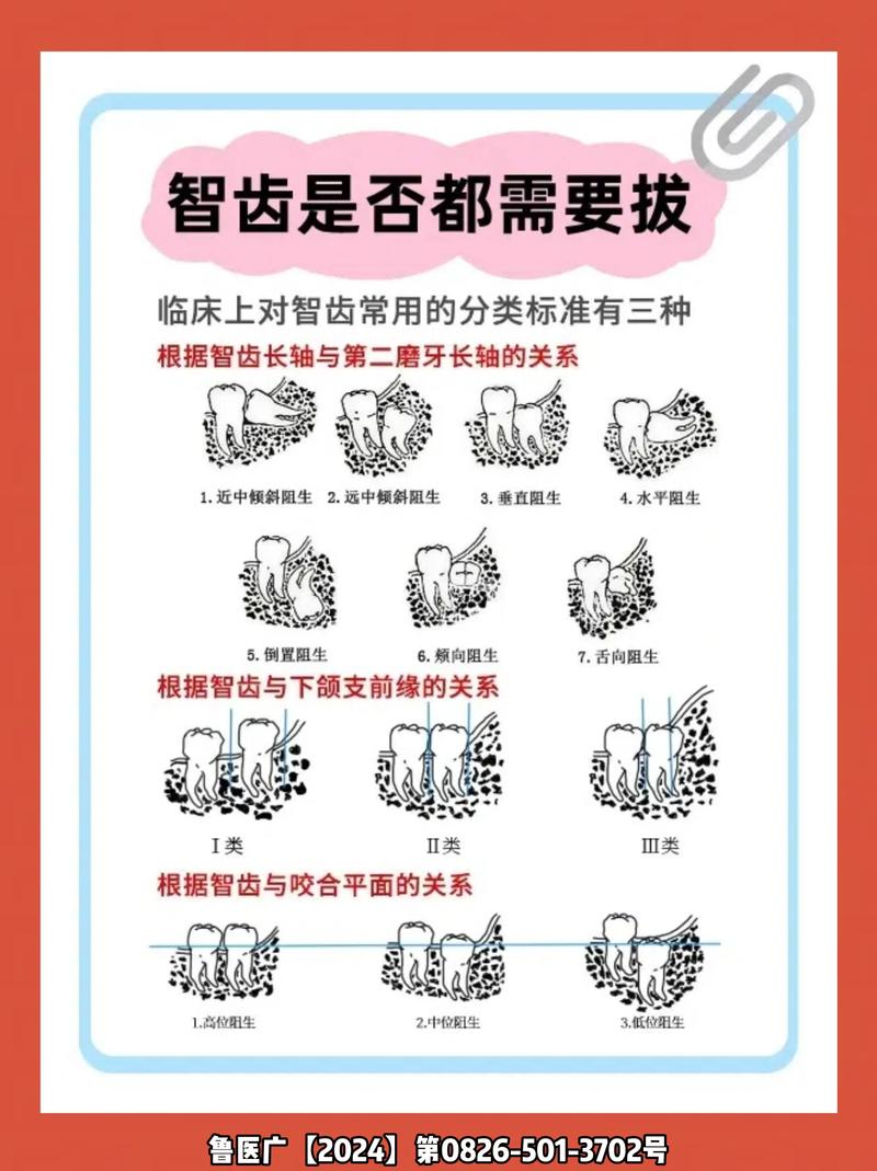 成人智齿拔除方法-图2