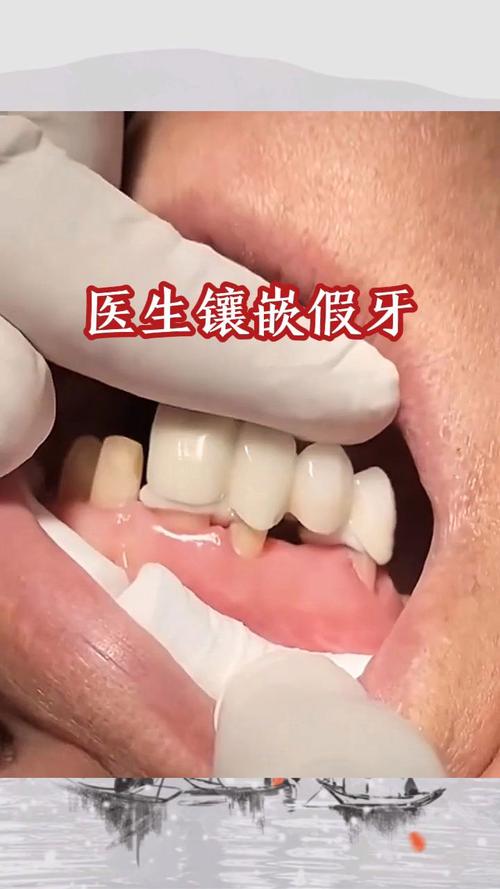 不种牙镶牙可行吗？有哪些替代选择？-图1