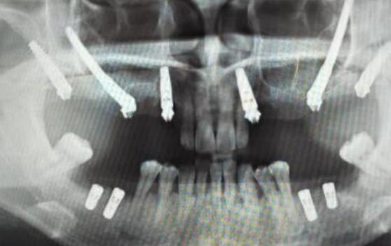 离上颌骨近种牙风险大吗？如何安全种植不伤骨？-图1