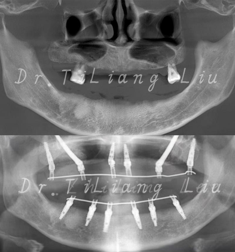 离上颌骨近种牙风险大吗？如何安全种植不伤骨？-图2