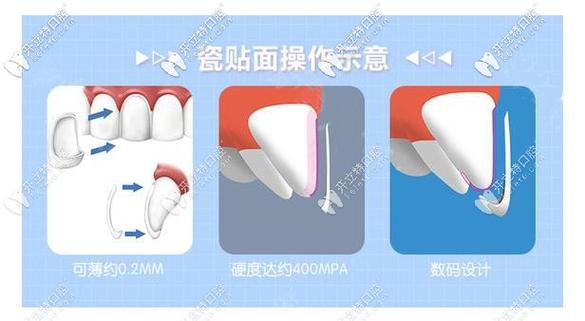牙齿贴面程序方法的具体步骤有哪些？-图2