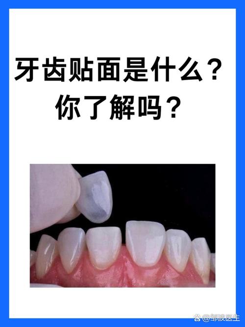 牙齿贴面程序方法的具体步骤有哪些？-图3