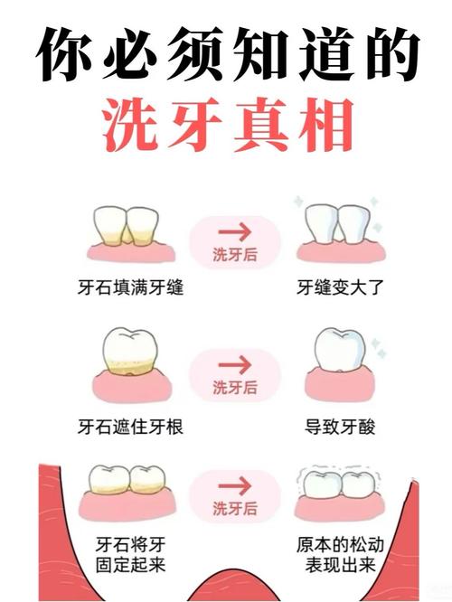种牙前必须洁牙马-图2