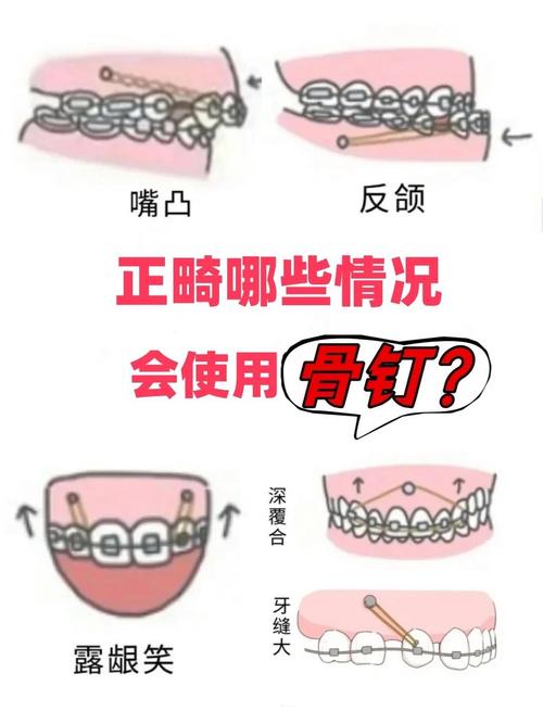 正畸支抗钉到底需不需要？一般要戴多久？-图3