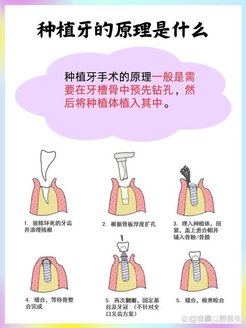 口腔种植的正确方法究竟该如何正确操作？-图3