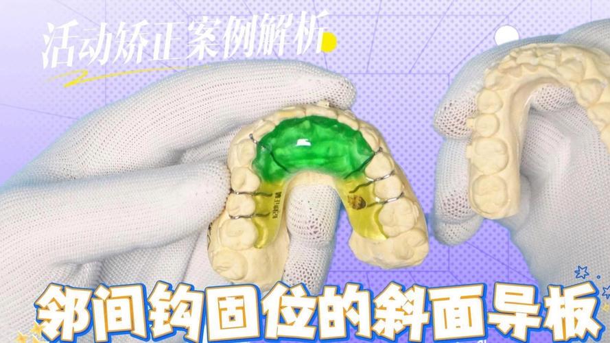 正畸期间咬合导板一般需要佩戴多长时间？-图3