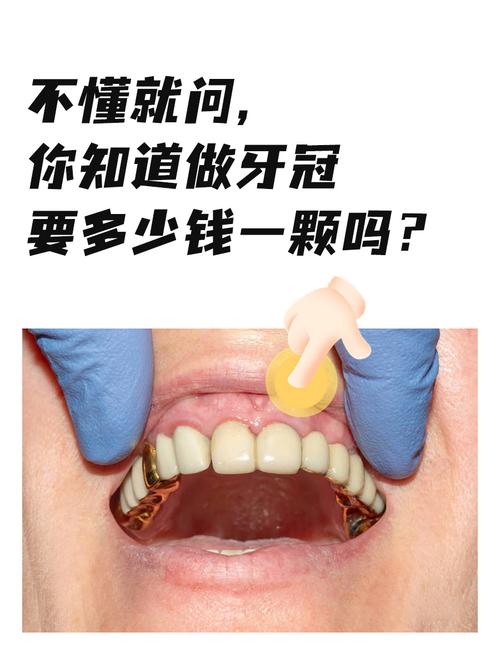 种植牙后需要多久才能安装牙冠？-图3