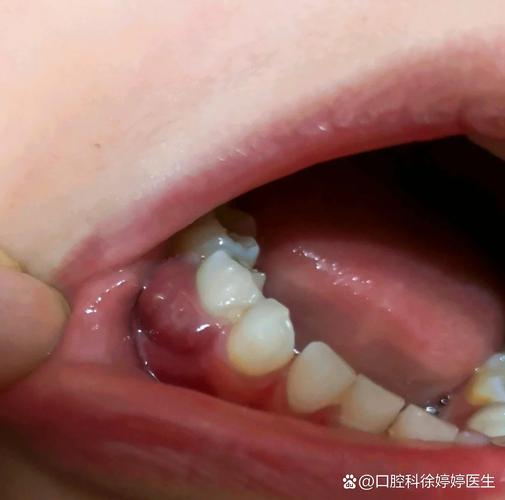 种牙后邻牙疼痛，背后原因究竟是什么？-图3