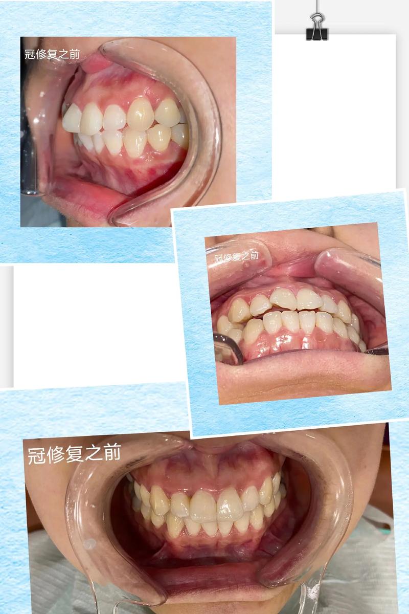 牙齿扭转的治疗方法有哪些具体方案?-图1 牙齿扭转的治疗方法有哪些具体方案?-图1