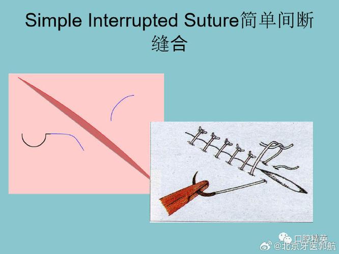 口腔种植缝合方法如何选择更优以减少并发症？-图1