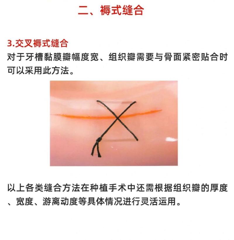 口腔种植缝合方法如何选择更优以减少并发症？-图3