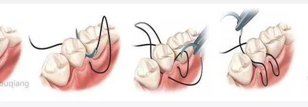 口腔种植缝合方法如何选择更优以减少并发症？-图2