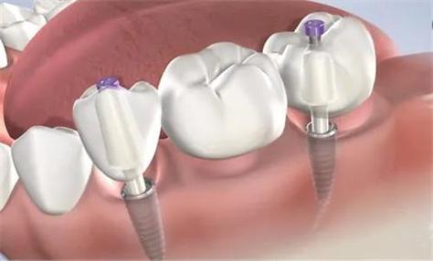 搭桥和种牙哪个好?选择关键看什么?-图1 搭桥和种牙哪个好?选择关键看什么?-图1