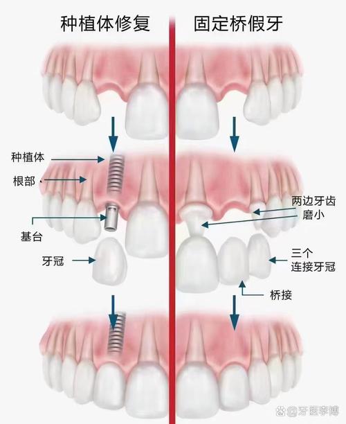 搭桥和种牙哪个好?选择关键看什么?-图2 搭桥和种牙哪个好?选择关键看什么?-图2