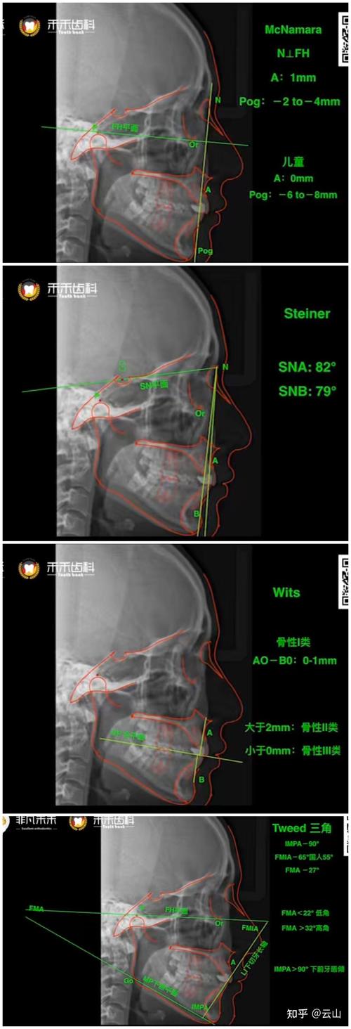 正畸头影测量多分软件如何提升诊断精准度？-图1