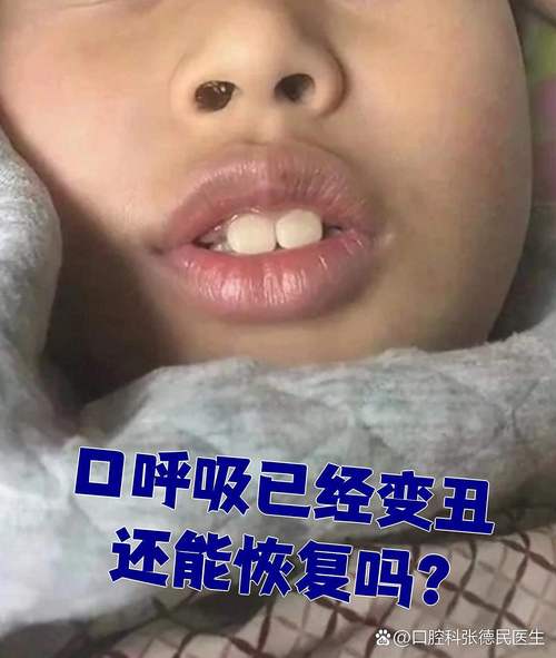 青少年口呼吸面容正畸能矫正出好脸型吗？-图3