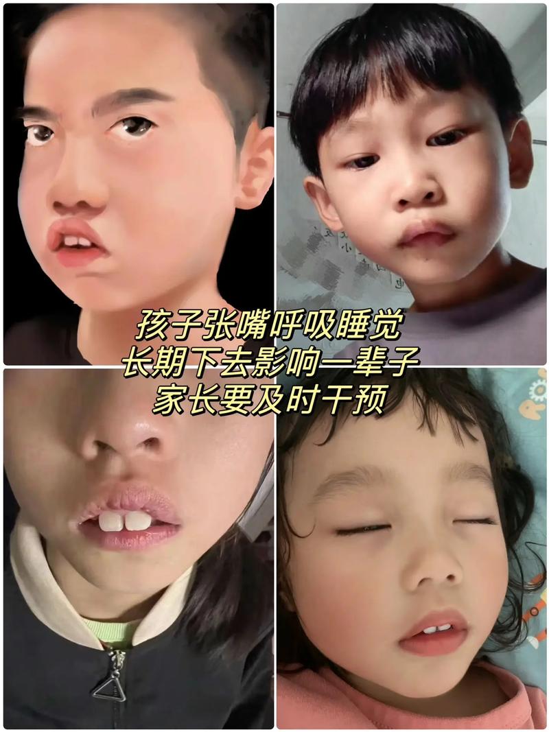 青少年口呼吸面容正畸能矫正出好脸型吗？-图1