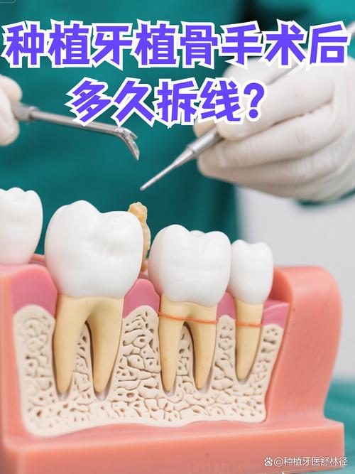 种牙后拆线时间多久？拆线时机有讲究吗？-图2