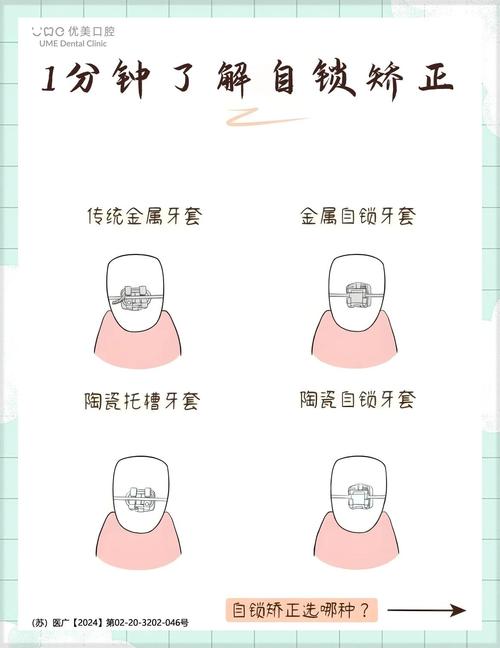 正畸主动自锁托槽是什么？原理优势说明-图3
