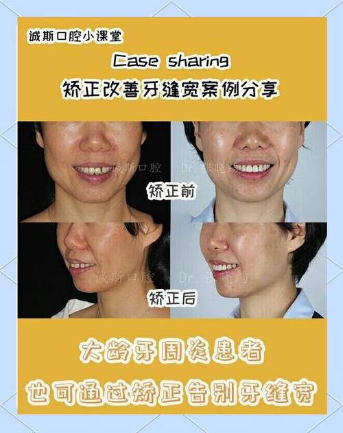 正畸会让牙缝变大吗？牙齿矫正后牙缝会变宽吗？-图2