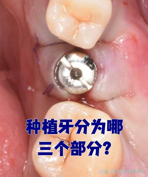 牙床窄可以种牙吗？窄牙床种牙需要什么条件？-图2