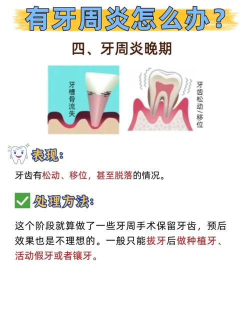 牙周病不治疗会引发哪些口腔及全身问题？-图2