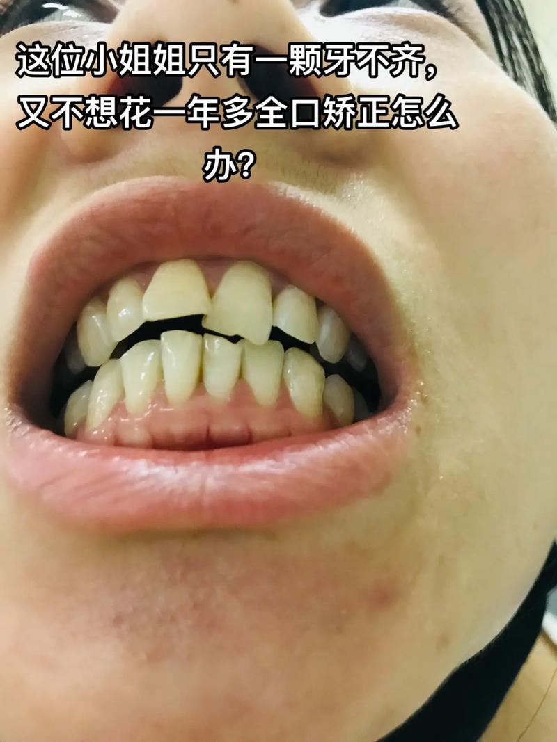 门牙不齐,哪种矫正方法最有效?如何选?-图1 门牙不齐,哪种矫正方法最有效?如何选?-图1