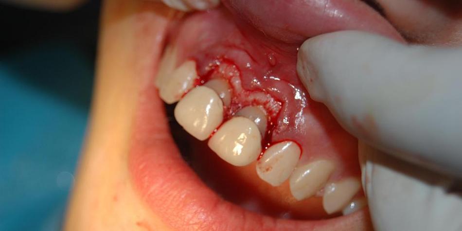 牙冠延长手术的常用方法具体有哪些呢?-图2 牙冠延长手术的常用方法具体有哪些呢?-图2