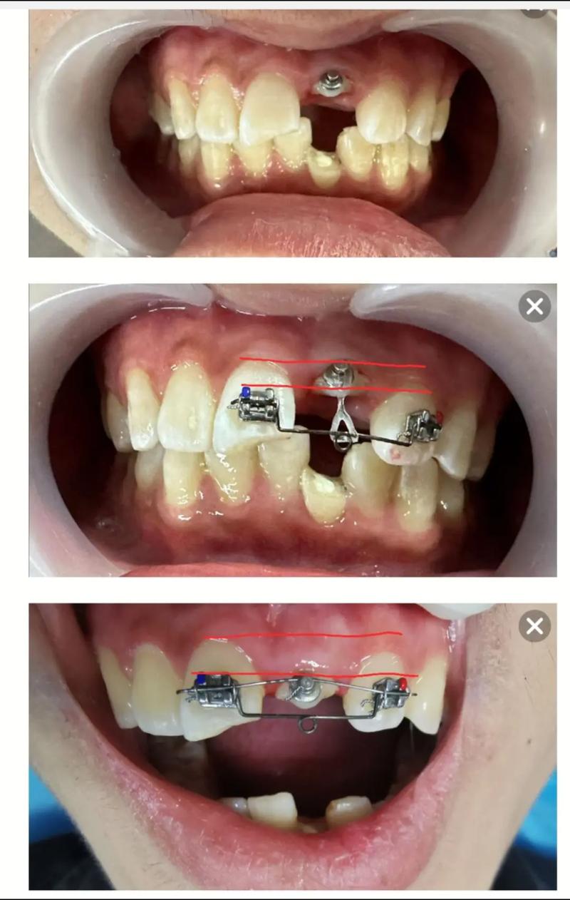 牙冠延长手术的常用方法具体有哪些呢?-图1 牙冠延长手术的常用方法具体有哪些呢?-图1