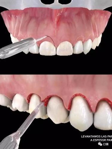 牙冠延长手术的常用方法具体有哪些呢?-图3 牙冠延长手术的常用方法具体有哪些呢?-图3