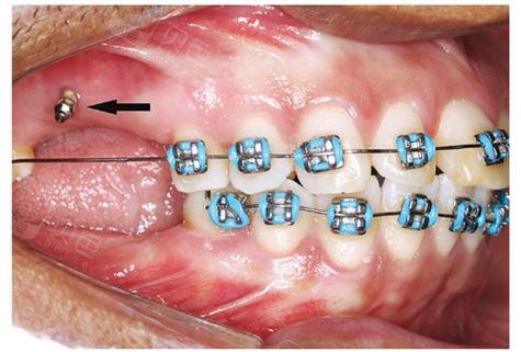 正畸支抗钉磨牙前移的操作步骤是怎样的?-图1 正畸支抗钉磨牙前移的操作步骤是怎样的?-图1