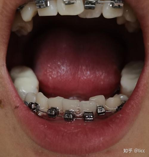 南京正畸整个疗程下来大概要花多少钱？-图3