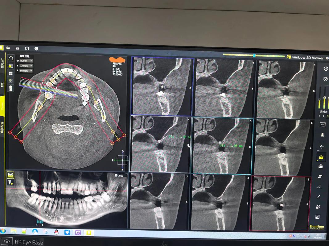 在进行种牙手术时，上颌骨厚度会受到怎样的影响？-图1