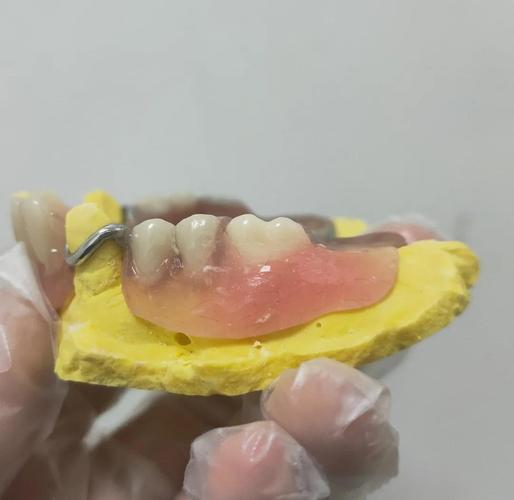 种牙时能否戴义齿？有哪些注意事项？-图1