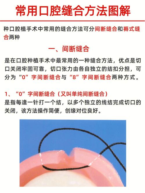 口腔缝合方法图片如何展示操作步骤与技巧？-图1