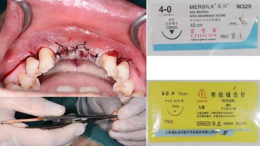 口腔缝合方法图片如何展示操作步骤与技巧？-图2
