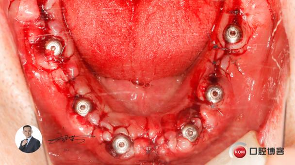 种牙外提手术视频能看清哪些关键步骤？-图2