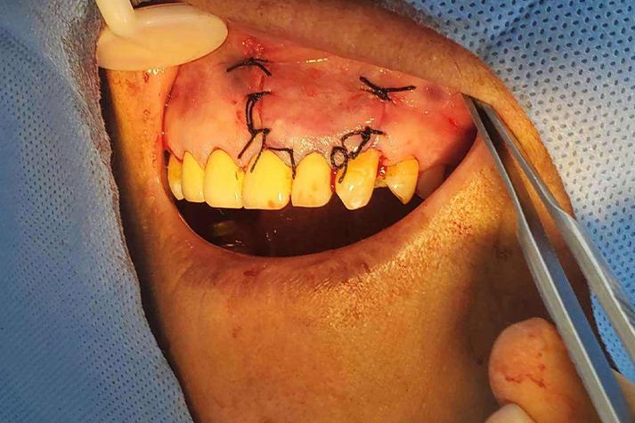 种牙后缝线处如何护理？会有肿胀疼痛吗？-图1