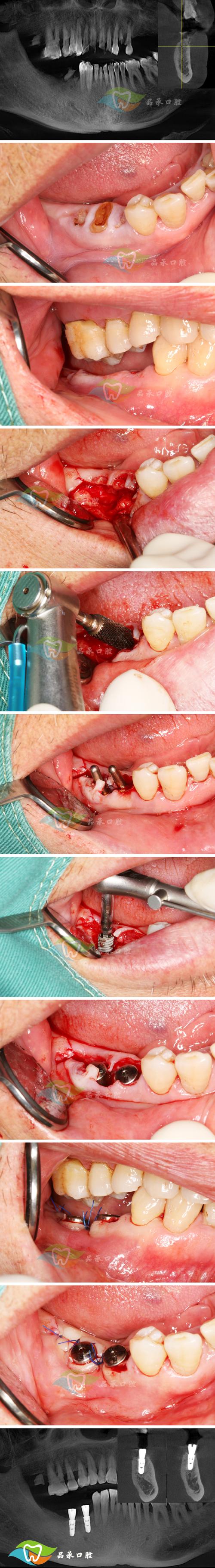 种牙后缝线处如何护理？会有肿胀疼痛吗？-图2