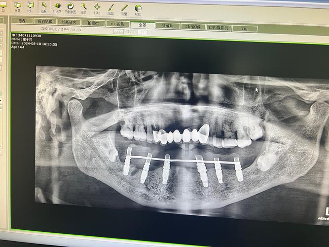 种牙前拍牙片定做，为何必须这样做？-图3