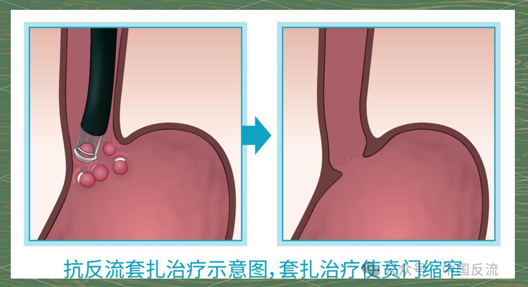 正畸连续结扎方法如何提升结扎效率与效果？-图3