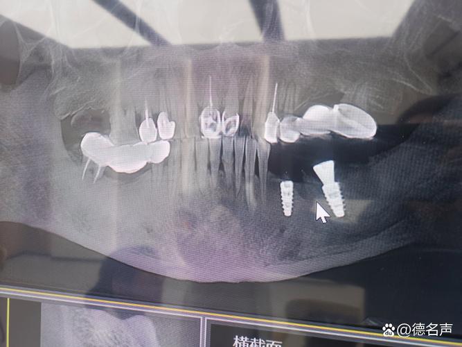 种牙时骨头短会影响种植吗？怎么解决？-图3