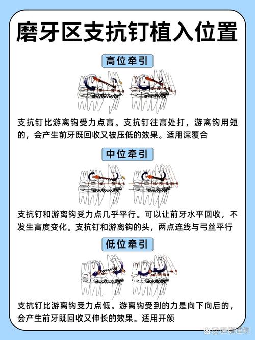 种牙为何要打支抗钉？作用和风险有哪些？-图2