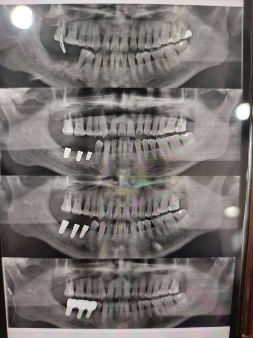 种牙前CT片拍摄需满足哪些具体要求？-图3