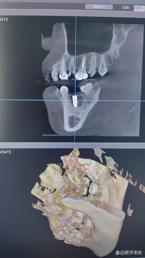 种牙前CT片拍摄需满足哪些具体要求？-图1
